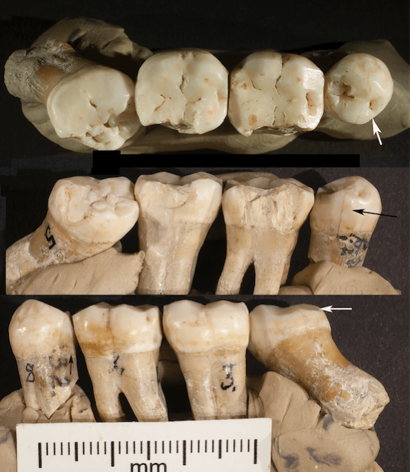Neanderthal teeth fossils shed light on prehistoric dentistry
