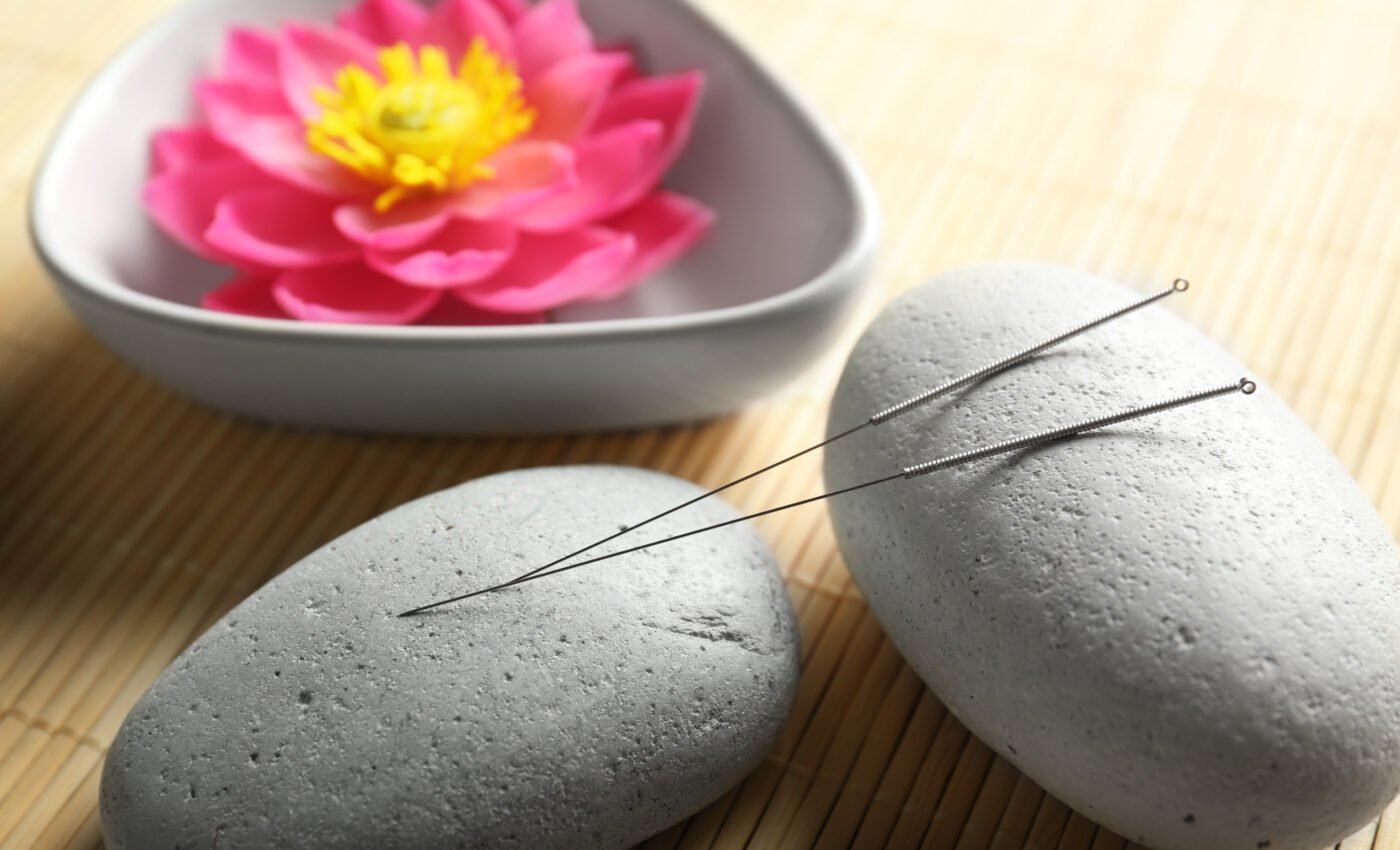 Acupuncture is a potential treatment for debilitating headaches